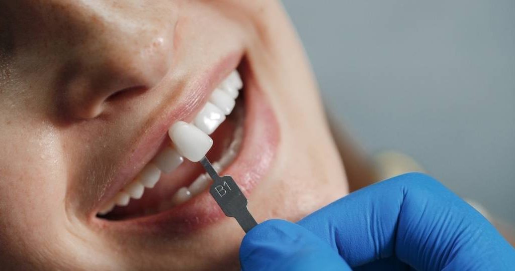 Lente de porcelana dental é mais eficaz